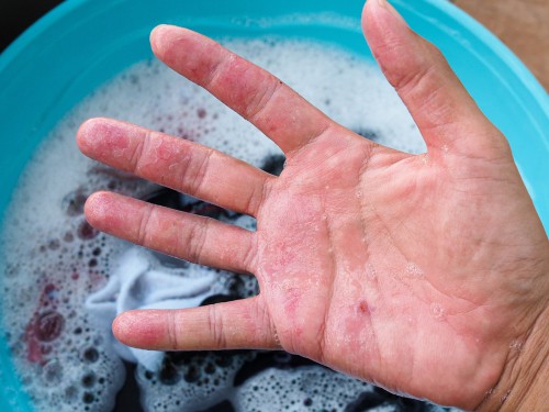 Tips On Using Cleaning Products To Clean Home When You Have Eczema